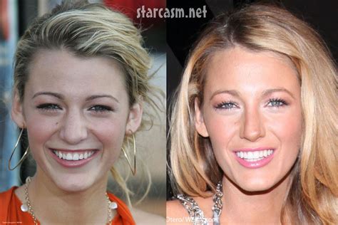 Has Blake Lively Had Plastic Surgery? Exploring the Rumors and Realities